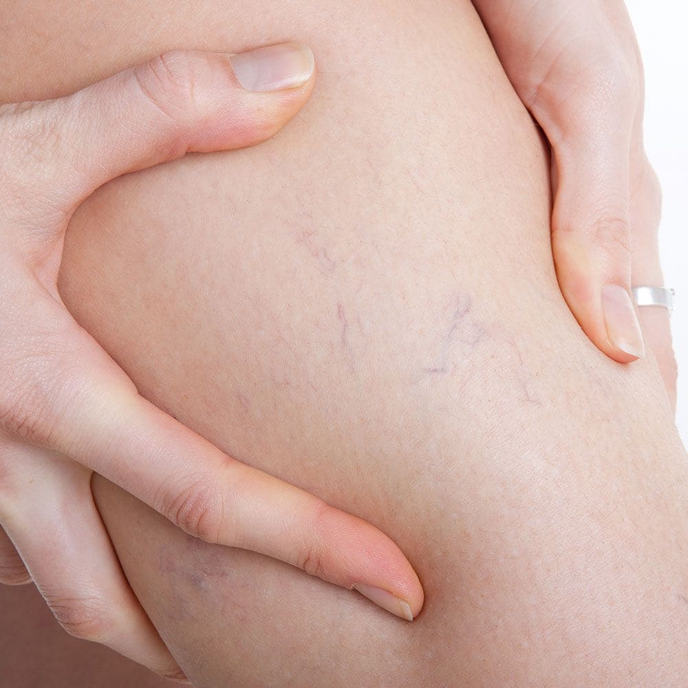 Mala circulacion - Especialista en várices - Dr. Carlos Acosta Uriegas - Vein Clinic