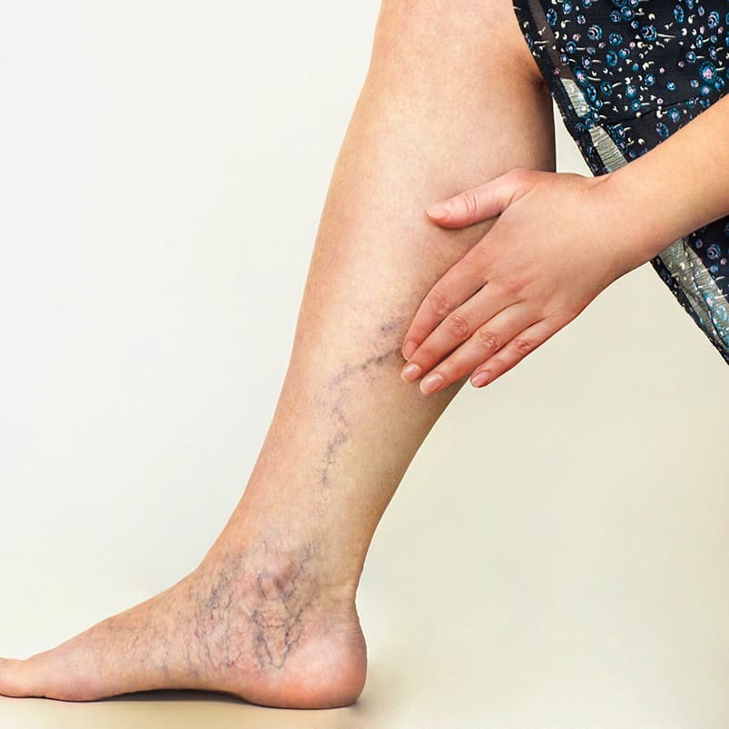 Varices  - Especialista en várices - Dr. Carlos Acosta Uriegas - Vein Clinic