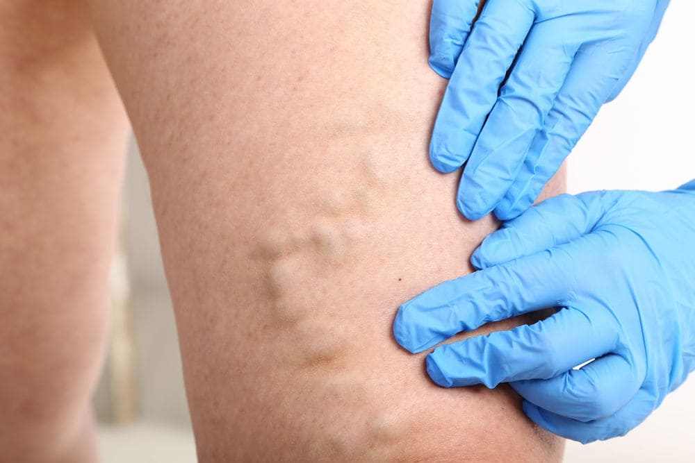 Dolor en venas- Especialista en várices - Dr. Carlos Acosta Uriegas - Vein Clinic