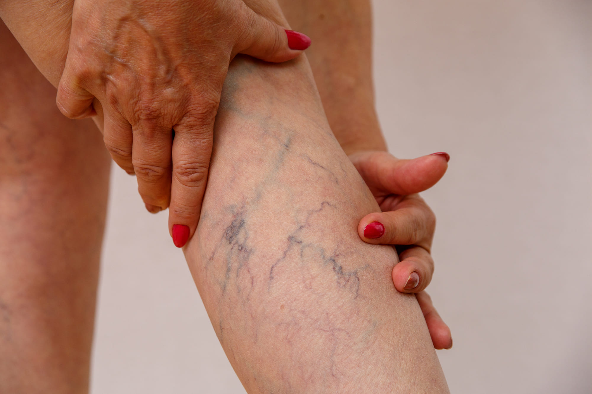 Varices - Especialista en várices - Dr. Carlos Acosta Uriegas - Vein Clinic